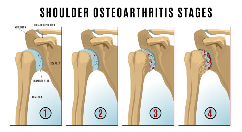 Stages of shoulder arthritis